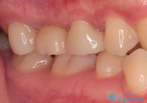 壊れやすいブリッジ インプラント治療で安定した咬み合わせにの治療前