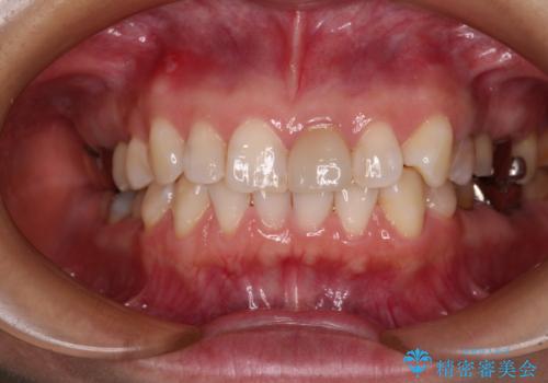 気になる下顎歯列のみをインビザラインで部分矯正の治療前