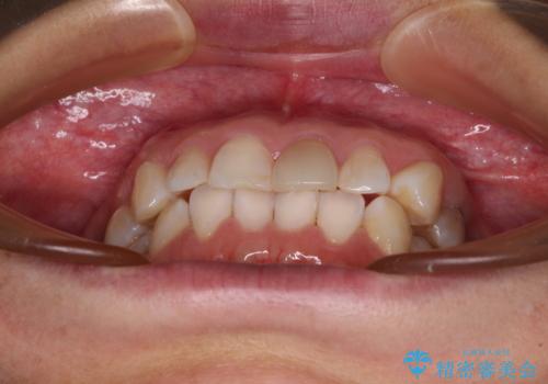 気になる下顎歯列のみをインビザラインで部分矯正の治療前