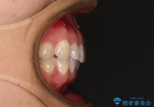 気になる下顎歯列のみをインビザラインで部分矯正の治療前