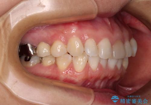 気になる下顎歯列のみをインビザラインで部分矯正の治療前