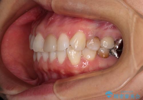 気になる下顎歯列のみをインビザラインで部分矯正の治療前