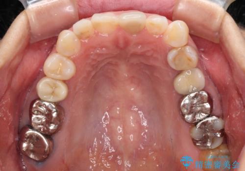 気になる下顎歯列のみをインビザラインで部分矯正の治療前