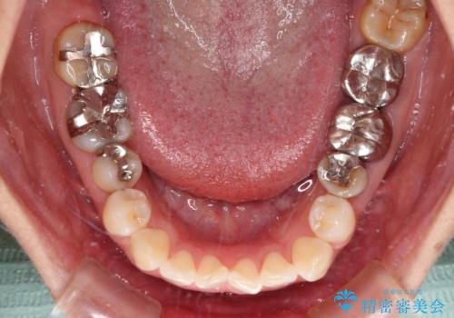 気になる下顎歯列のみをインビザラインで部分矯正の治療前