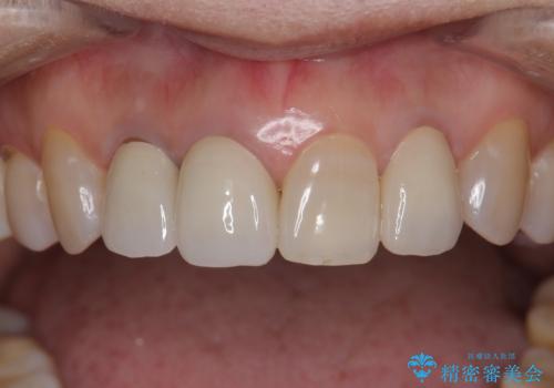 前歯のかぶせもののやり直し、根の治療もの症例 治療後