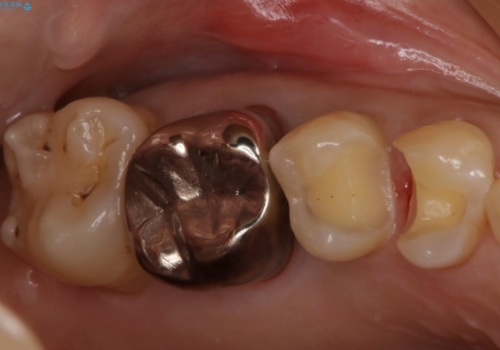 歯がしみる セラミックインレーで改善の治療中