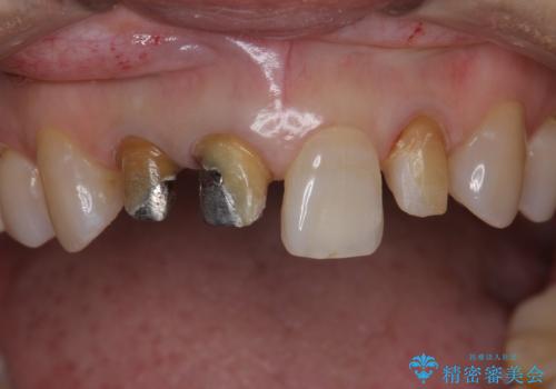 前歯のかぶせもののやり直し、根の治療もの治療中
