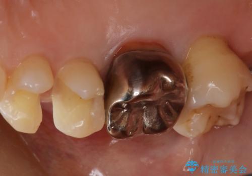歯がしみる セラミックインレーで改善の治療中