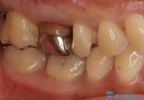 歯がしみる セラミックインレーで改善の治療中