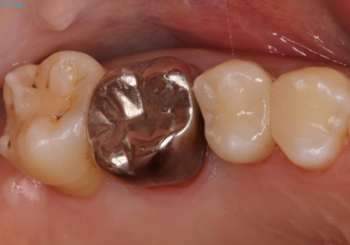 歯がしみる セラミックインレーで改善の症例 治療後