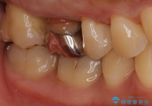 歯がしみる セラミックインレーで改善の治療後