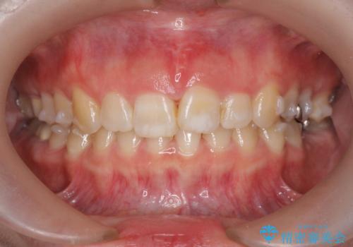 ねじれた前歯を改善するマウスピース矯正の治療中