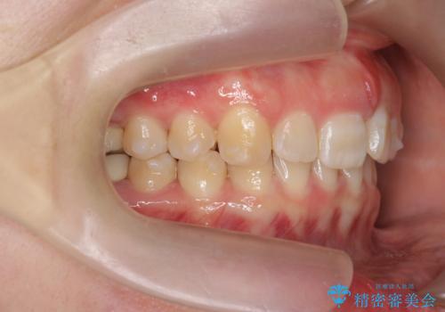 ねじれた前歯を改善するマウスピース矯正の治療中
