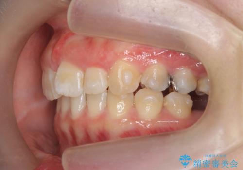 ねじれた前歯を改善するマウスピース矯正の治療中