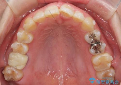 ねじれた前歯を改善するマウスピース矯正の治療中
