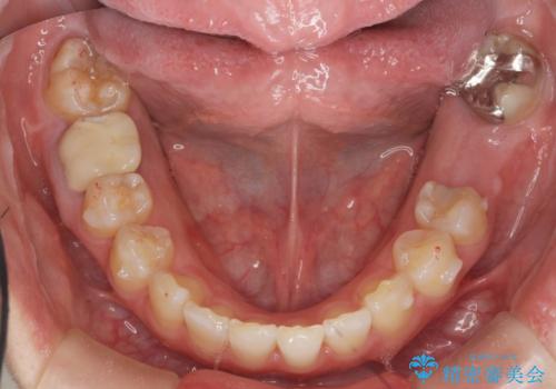 ねじれた前歯を改善するマウスピース矯正の治療中