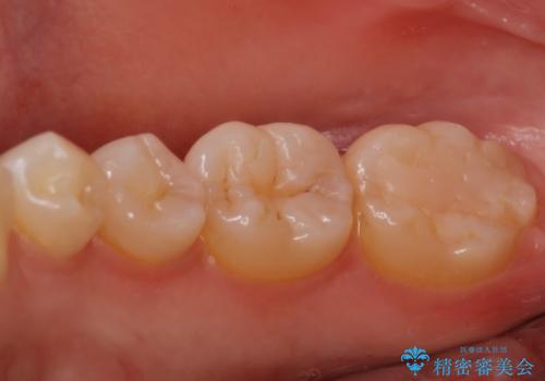 昔治した歯の形が気になる　セラミックインレーでキレイな歯に!の症例 治療前