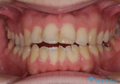 しゃくれて口が閉じられない ワイヤー装置での抜歯矯正の治療前