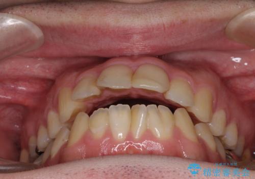 しゃくれて口が閉じられない ワイヤー装置での抜歯矯正の治療前