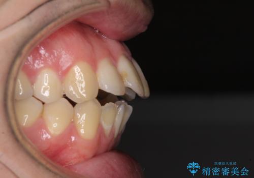 しゃくれて口が閉じられない ワイヤー装置での抜歯矯正の治療前