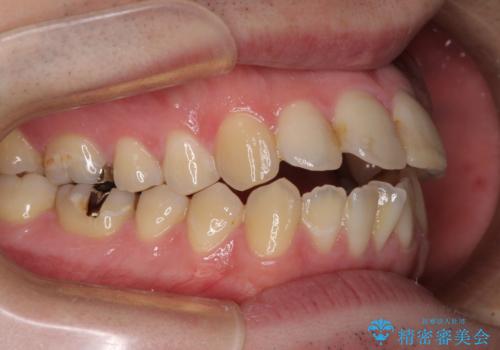 しゃくれて口が閉じられない ワイヤー装置での抜歯矯正の治療前