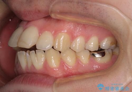 しゃくれて口が閉じられない ワイヤー装置での抜歯矯正の治療前