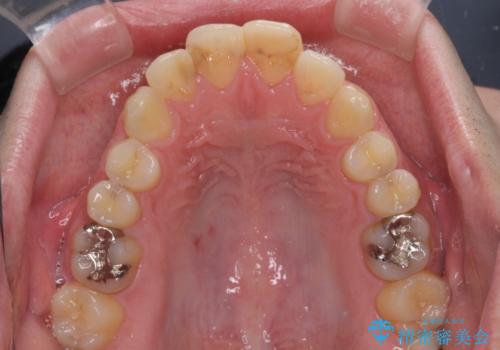 しゃくれて口が閉じられない ワイヤー装置での抜歯矯正の治療前