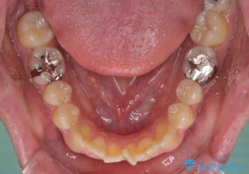 しゃくれて口が閉じられない ワイヤー装置での抜歯矯正の治療前