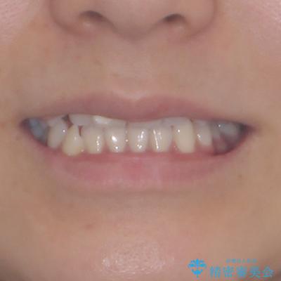 咬み合わせの乱れを改善 ワイヤー装置で楽々矯正治療の治療前(顔貌)