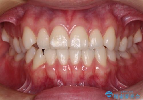 咬み合わせの乱れを改善 ワイヤー装置で楽々矯正治療の症例 治療前