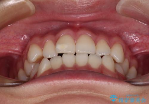 咬み合わせの乱れを改善 ワイヤー装置で楽々矯正治療の治療前