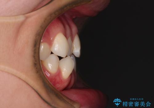 咬み合わせの乱れを改善 ワイヤー装置で楽々矯正治療の治療前