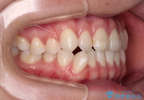 咬み合わせの乱れを改善 ワイヤー装置で楽々矯正治療の治療前