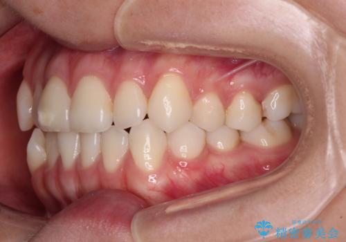 咬み合わせの乱れを改善 ワイヤー装置で楽々矯正治療の治療前