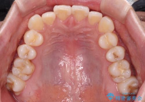 咬み合わせの乱れを改善 ワイヤー装置で楽々矯正治療の治療前