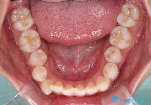 咬み合わせの乱れを改善 ワイヤー装置で楽々矯正治療の治療前