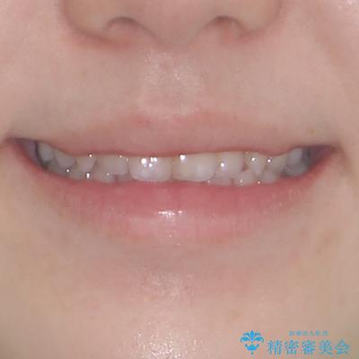 すきっ歯をインビザラインできれいな歯並びに改善の治療前（顔貌）
