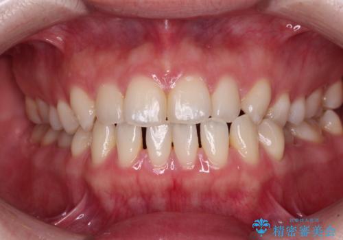 すきっ歯をインビザラインできれいな歯並びに改善の症例 治療前