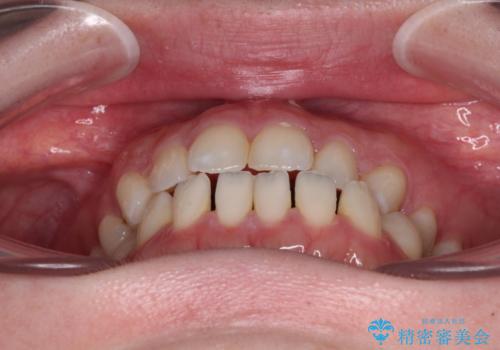 すきっ歯をインビザラインできれいな歯並びに改善の治療前