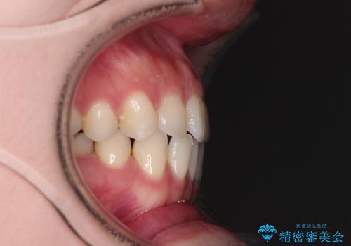 すきっ歯をインビザラインできれいな歯並びに改善の治療前