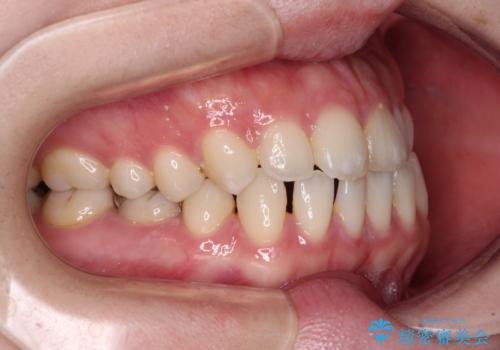 すきっ歯をインビザラインできれいな歯並びに改善の治療前