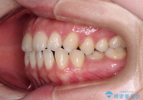 すきっ歯をインビザラインできれいな歯並びに改善の治療前