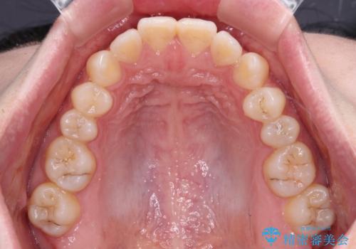 すきっ歯をインビザラインできれいな歯並びに改善の治療前