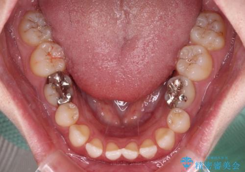 すきっ歯をインビザラインできれいな歯並びに改善の治療前