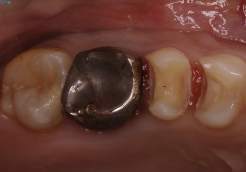 歯の間に食べ物がよく挟まるのを治したいの治療中
