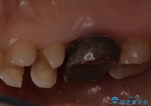 歯の間に食べ物がよく挟まるのを治したいの治療中