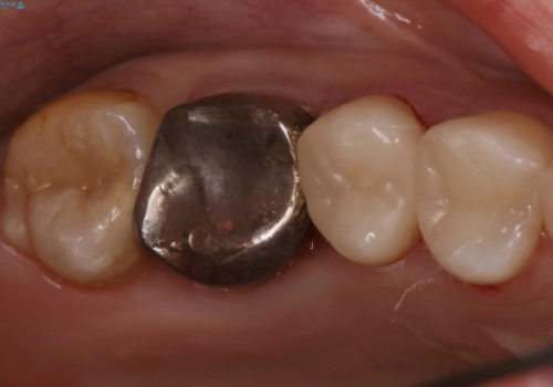 歯の間に食べ物がよく挟まるのを治したいの症例 治療後