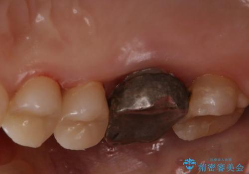 歯の間に食べ物がよく挟まるのを治したいの治療後