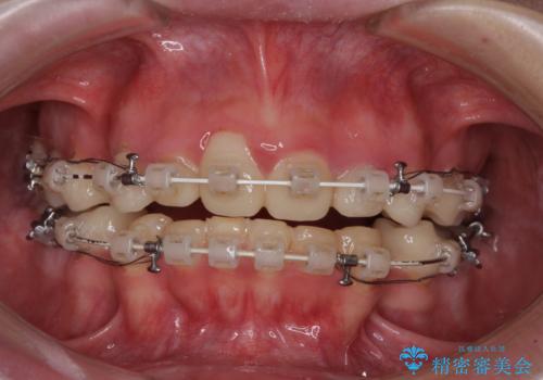 酸蝕歯でボロボロの歯の審美歯科治療　矯正治療も併用して、美しい口元への治療中