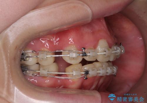 酸蝕歯でボロボロの歯の審美歯科治療　矯正治療も併用して、美しい口元への治療中